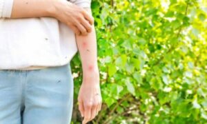 le zanzare sono fastidiose per l'uomo e le loro punture potrebbero essere letali
